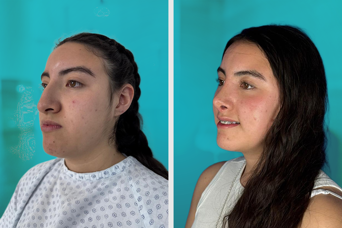 Rinoplastia Antes y Después