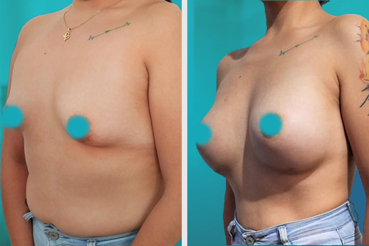 Lifting Facial Resultado